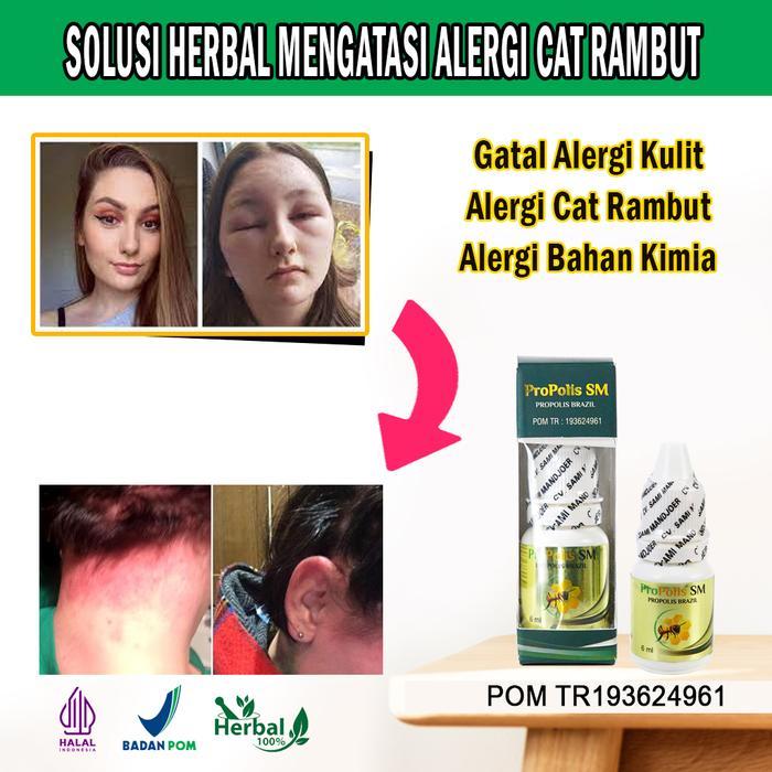 Obat Gatal Alergi Kulit, Alergi Cat Rambut, Alergi Bahan Kimia