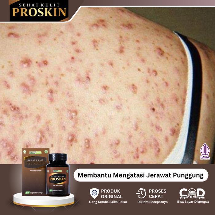 {Proskin} Suplemen Untuk Mengatasi Gatal Di Punggung, Jerawat Punggung, Gatal Di Badan, Gatal Karena