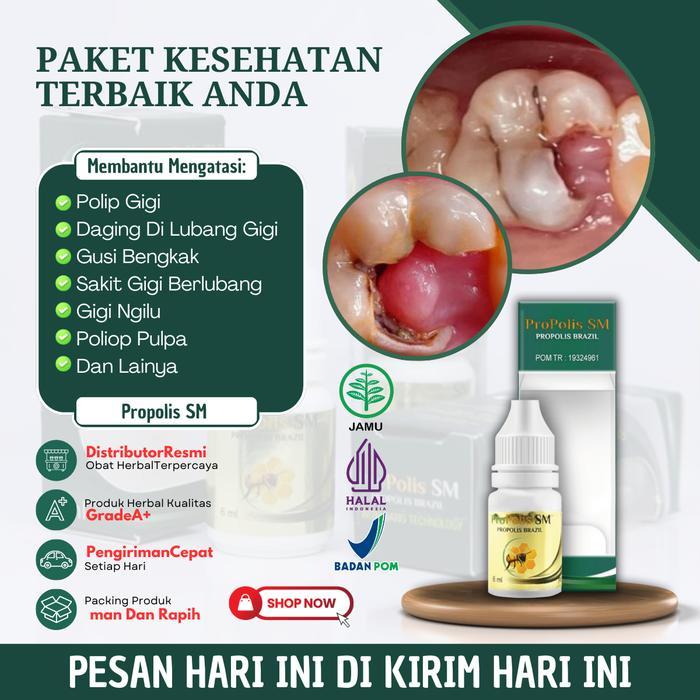 Propolis SM Solusi Untuk Mengatasi Polip Gigi, Daging Di Lubang Gigi, Gusi Tumbuh Di Lubang Gigi,