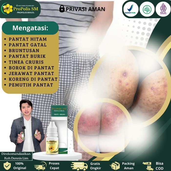 Propolis SM - Salep Gatal Pantat, Pantat Hitam burik, pantat beruntusan, Tinea Cruris, Jerawat