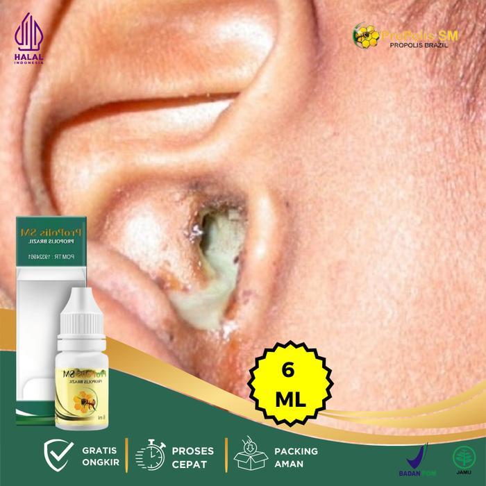 Tetes Kotoran Telinga, Telinga Berair, Tetes Telinga Congek Menahun Dewasa Dan Anak, Penghancur