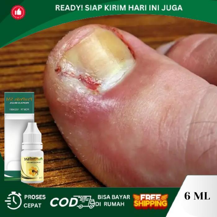Tetes Cantengan Jempol Kaki, Kuku Jempol Nyeri Bau Busuk, Jempol Kaki Bengkak Bernanah, Kuku Jamur