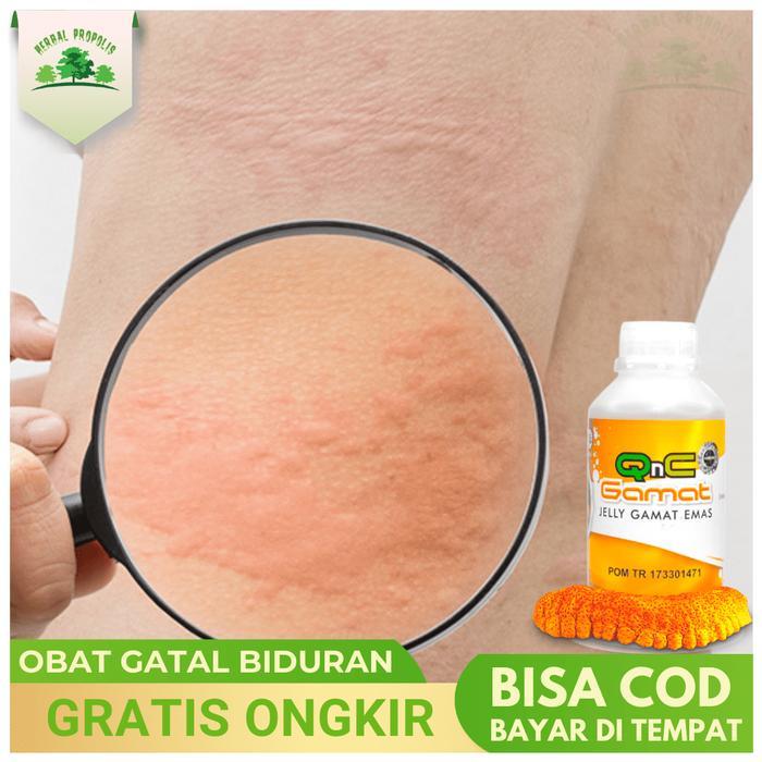 OBAT BIDURAN TRADISIONAL MENAHUN KRONIS ALERGI KULIT, QNC JELLY GAMAT