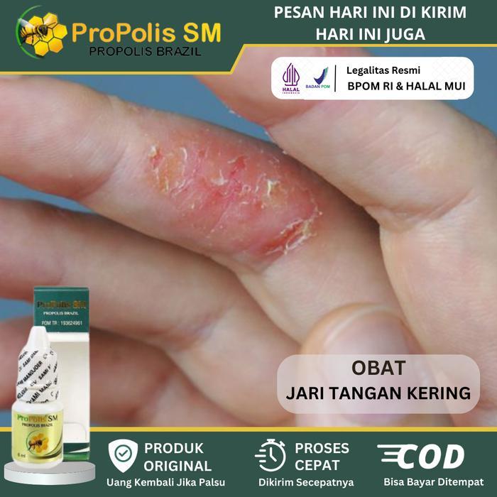 Herbal Tetes Jari Tangan Kering, Kulit Alergi Detergen, Kulit Mengelupas, Jari Tangan Kasar, Kulit