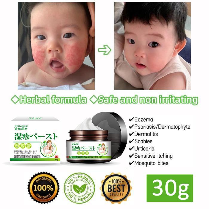 Terlaris salep gatal paling ampuh salep eksim salep kadas kurap gatal ampuh salap gatal kulit yang