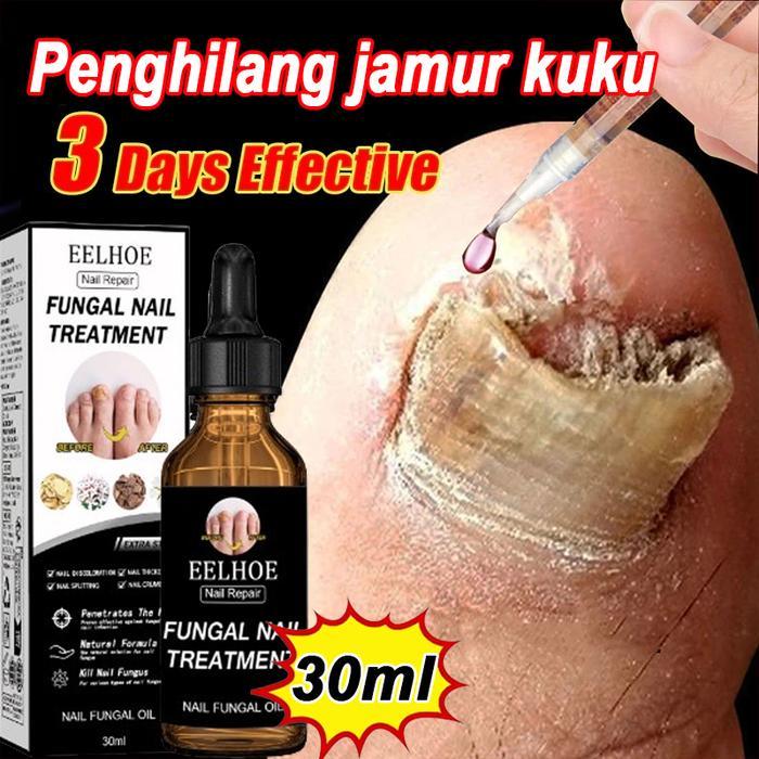 Obat Jamur Kuku Obat kuku jamur dan rusak Perawatan Kuku Berjamur Antibakteri Perawatan Kuku