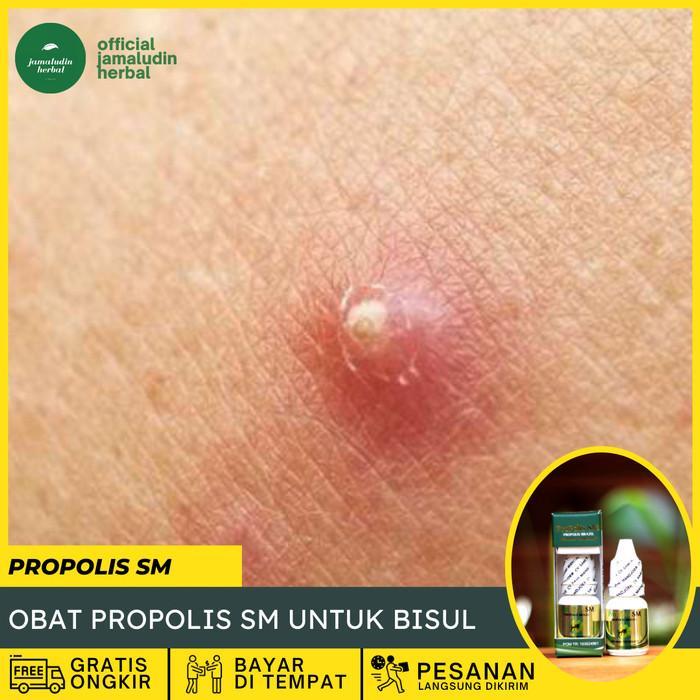 Obat Bisul di Kemaluan Wanita PROPOLIS SM ASLI