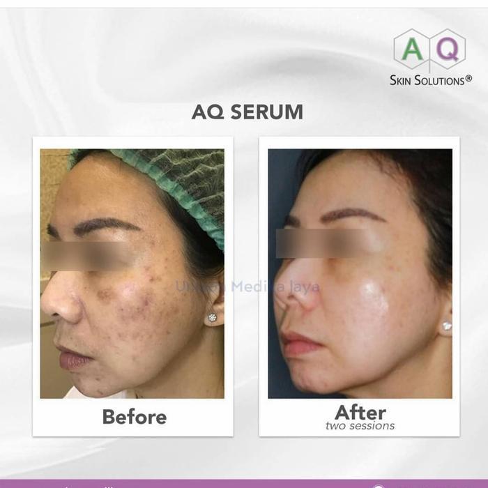 Aq Skin Solutions Solution Recovery Serum Human Growth Factor Terapi Scar