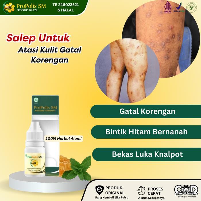 Salep Penghilang Koreng Di Kulit, Penghilang Bekas Gigit Nyamuk, Luka Gatal Bernanah, Luka Bekas