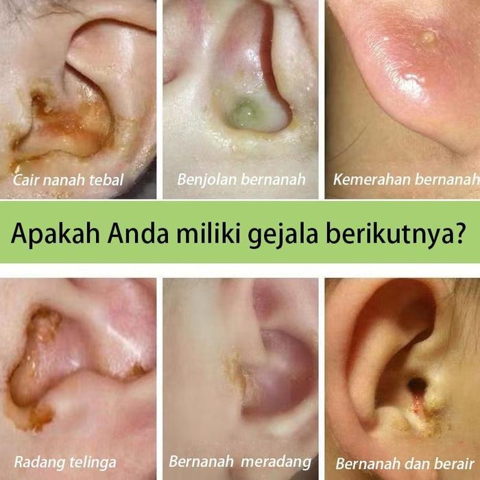 Obat Tetes Telinga Radang Telinga Infeksi Telinga Pendengaran Meredam Obat Telinga Bernanah Obat