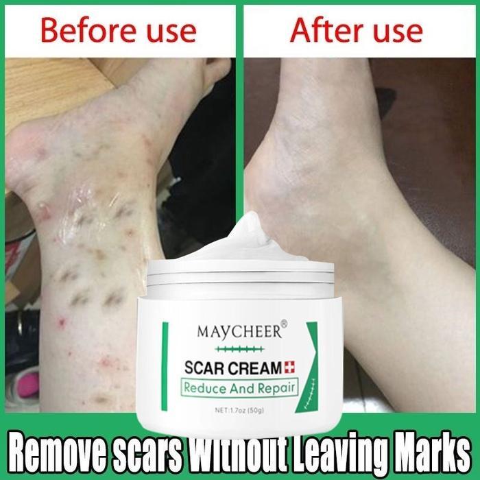 Penghilang Bekas Luka Hitam Koreng Penghilang Bekas Luka Di Kaki Penghilang Bekas Cacar Bekas