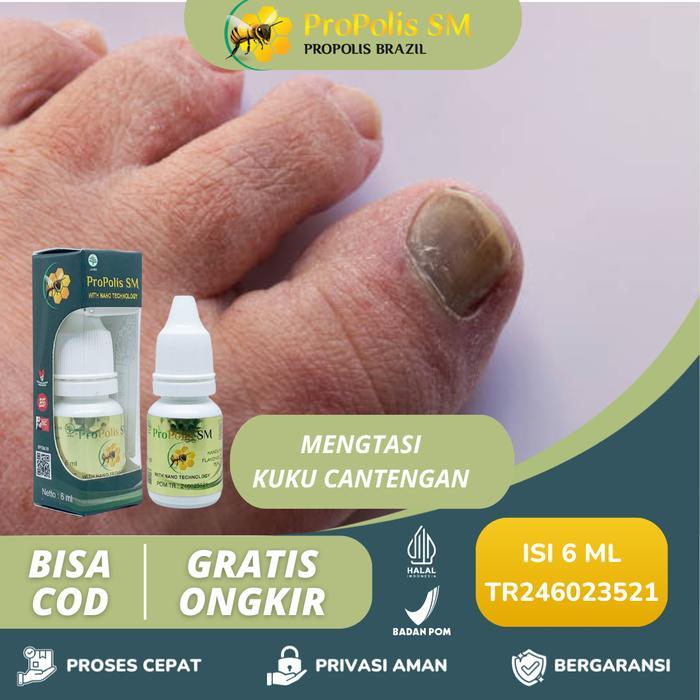 Propoli SM - Untuk Kuku Cantengan Perawatan Jempol Kaki bengkak Bernanah Jamuran Kutu Air Kapalan