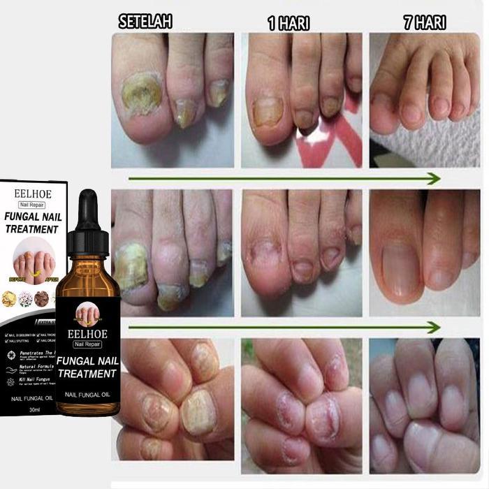 OBAT JAMUR KUKU OBAT KUKU JAMUR DAN RUSAK PERAWATAN KUKU BERJAMUR ANTIBAKTERI PERAWATAN KUKU