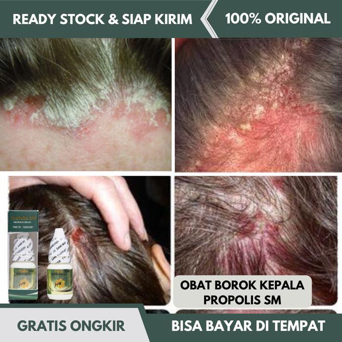 OBAT BOROK DI KULIT KEPALA, OBAT PSORIASIS, OBAT KEPALA BOROK, CENANG