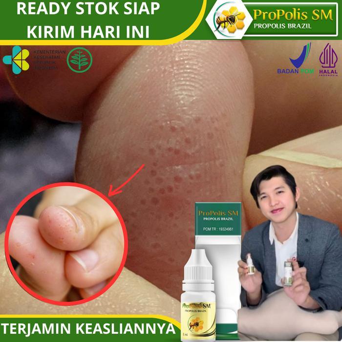 Propolis Sm - Untuk Penghilang Gatal Di Ujung Jari / Sela Jari Tangan, Gatal Kutu Air, Alergi