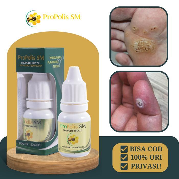 Obat Mata Ikan Di Telapak Kaki Tangan, Obat Perontok Mata Ikan Kapalan