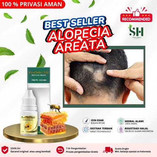 Propolis SM Untuk Rambut Rontok dan Rusak, Alopecia areata, penumbuh rambut pitak, botak koin,