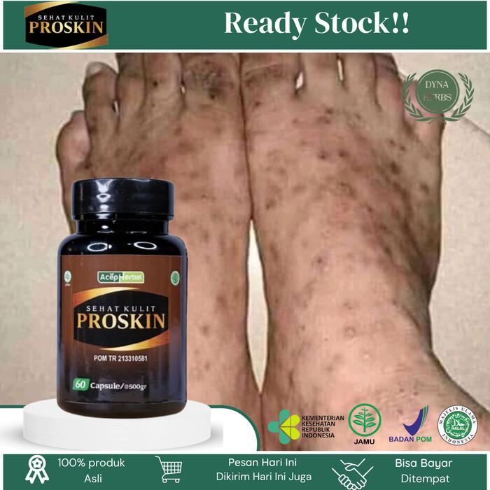 Budug Bernanah Di Kaki, Penghilang Bekas Koreng Di Kaki, Koreng Di Kaki, Penghilang Bekas Luka