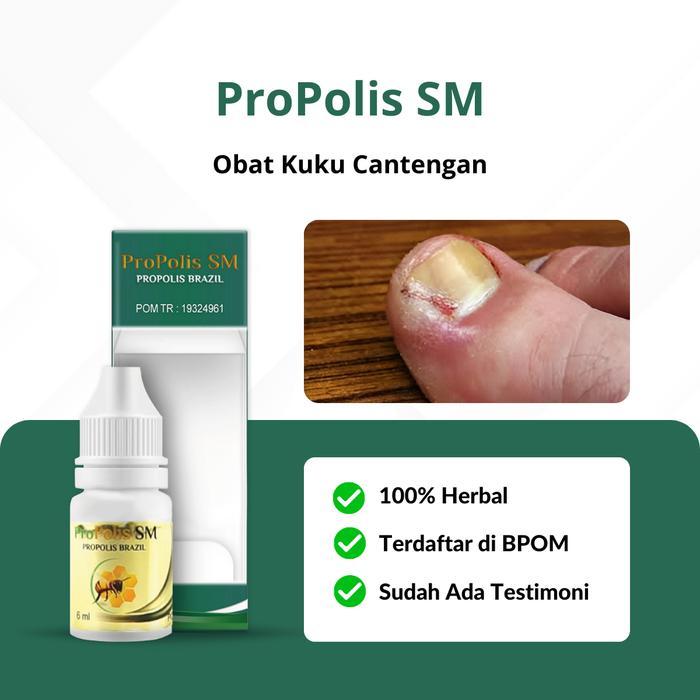 Obat Cantengan Jempol Kaki Bengkak, Obat Jamur Kuku Kaki, Propolis SM