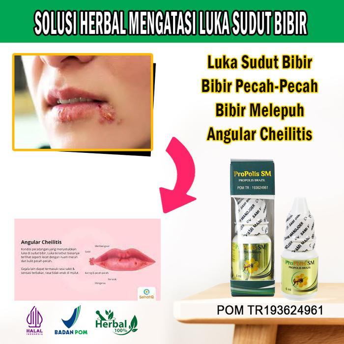 Obat Sudut Bibir Luka, Bibir Pecah-Pecah & Kering, Bibir Melepuh