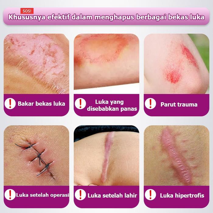 PENGHILANG BEKAS LUKA HITAM KORENG SALEP PENGHILANG BEKAS LUKA PENGHILANG BEKAS LUKA ANAK 20G