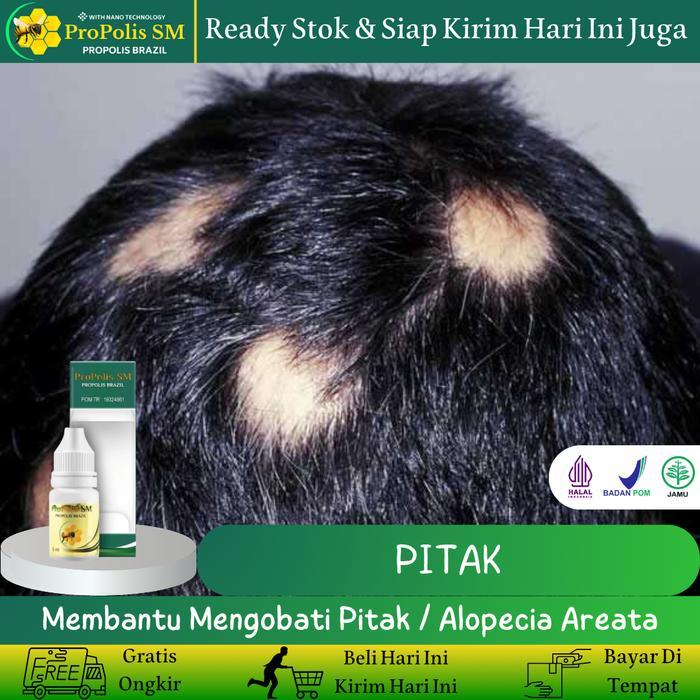 Propolis SM - Herbal untuk Pitak, Alopecia Areata, Botak Koin