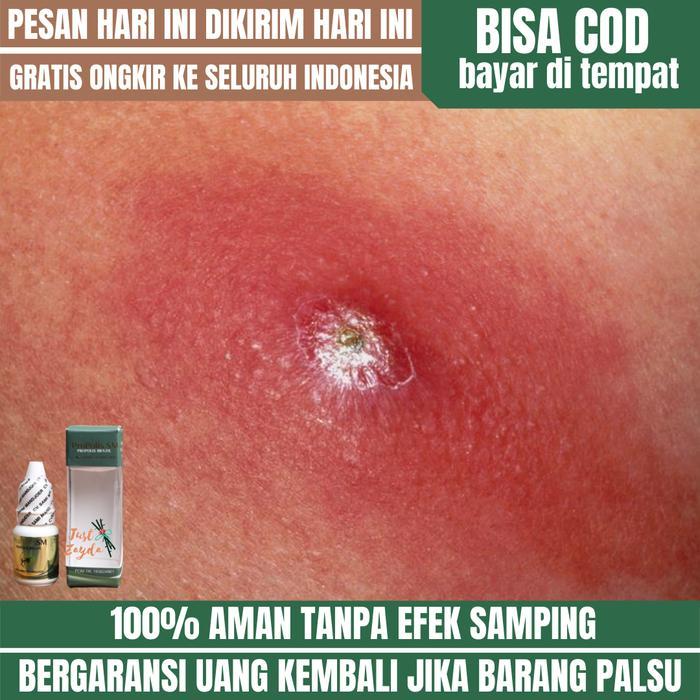 Obat Bisulan, Obat Bisul Di Pantat, Obat Bisul Udun, Bisul Bernanah