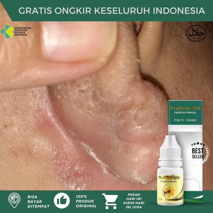Telinga Berkerak, Salep Psoriasis Kulit, Borok Di Telinga, Gatal Bernanah Di Telinga, Kulit