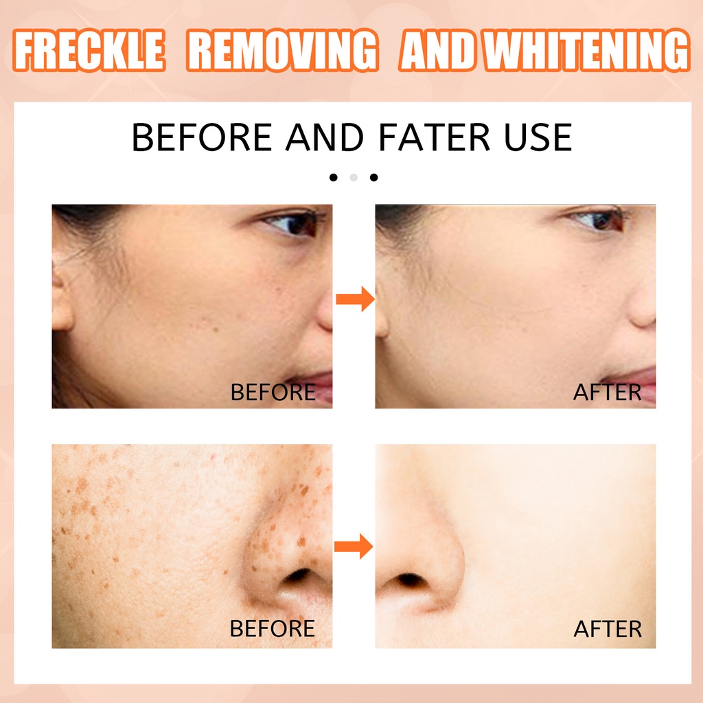 EELHOE Pibamy Pen Penghilang Melasma Pena Penghapus Flek Hitam Vitamin C Pen Penghilang Wajah Pemutih Mencerahkan kulit Flek Hitam Acne Removal Cream